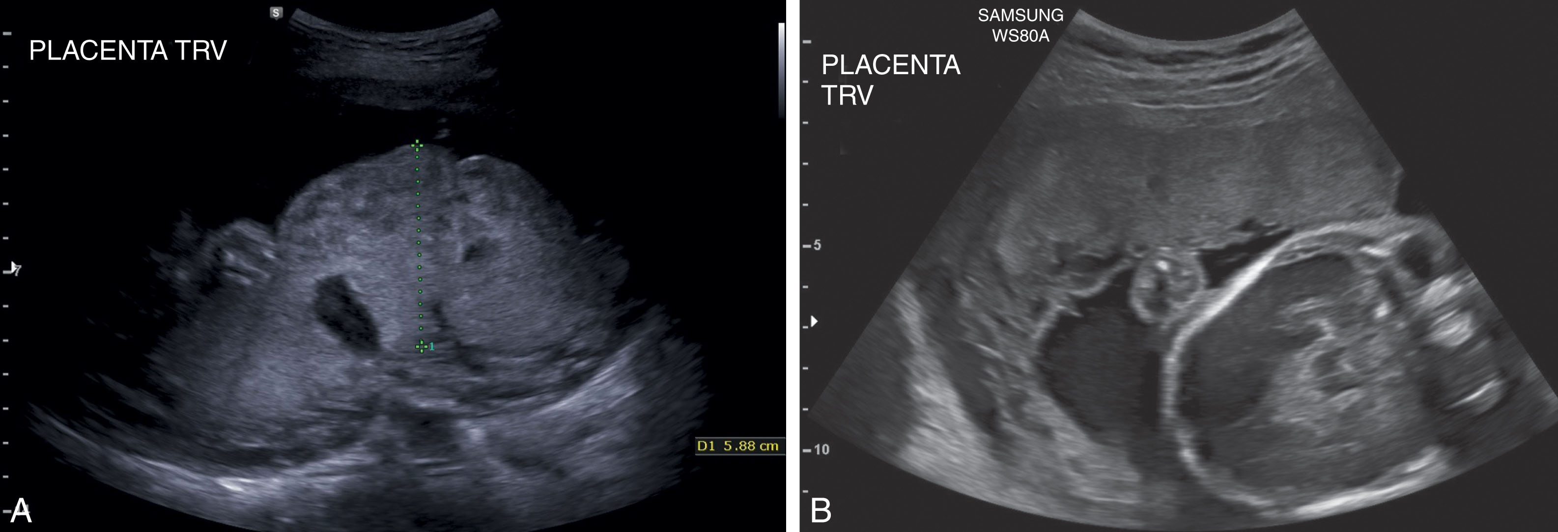 Fig. 56.8, (A) Placentomegaly. The anterior-posterior thickness of the placenta measures 5.88 cm. Calipers should be placed perpendicular to the placental borders. (B) Small placenta. This transverse image of a placenta extended from the maternal right sidewall to the maternal umbilicus. At 28 weeks of gestation, the fetus was growth restricted.