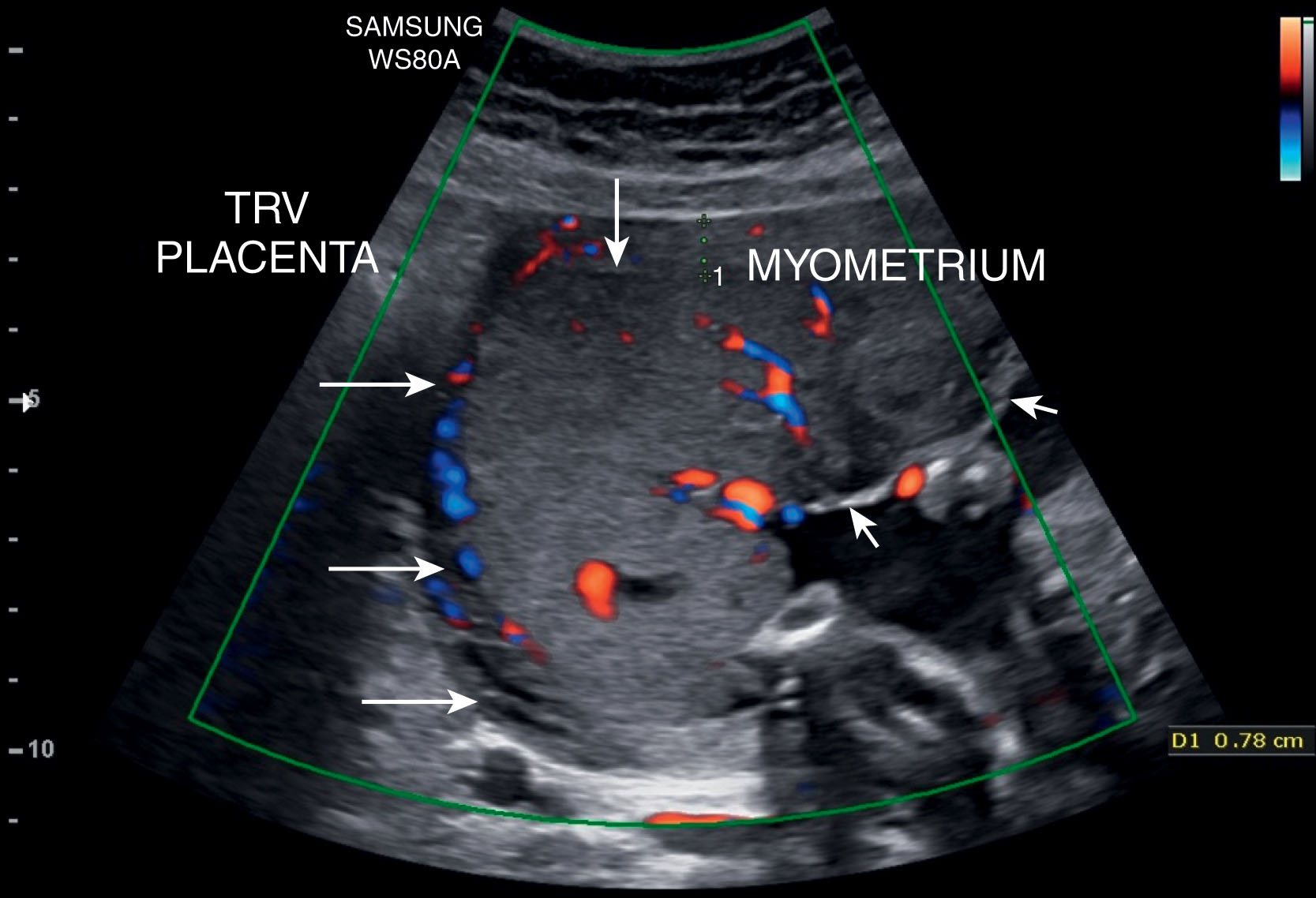 Fig. 56.9, Anterior right sidewall placenta demonstrating a smooth homogeneous sonographic appearance. The chorionic plate (short arrow) can be seen on the fetal surface of the placenta, and the basal surface (long arrows) can be seen adjacent to the myometrium, which measures 7.8 mm in an anterior-posterior dimension along the anterior uterine wall.