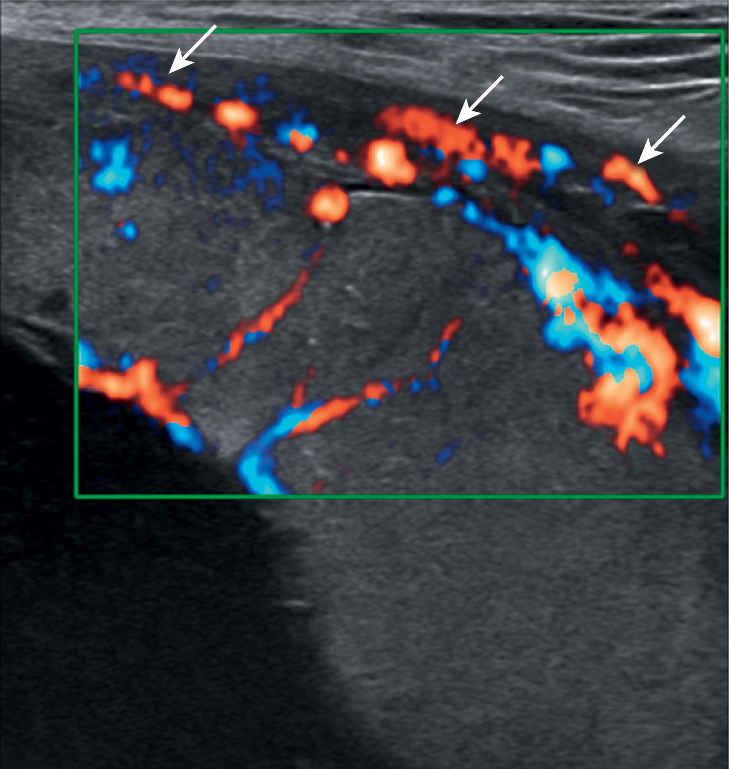 Fig. 56.10, Color Doppler demonstrates the normal vascularity of the chorionic plate, placental vessels, basal area of the placenta, and the maternal blood vessels (arrow) .