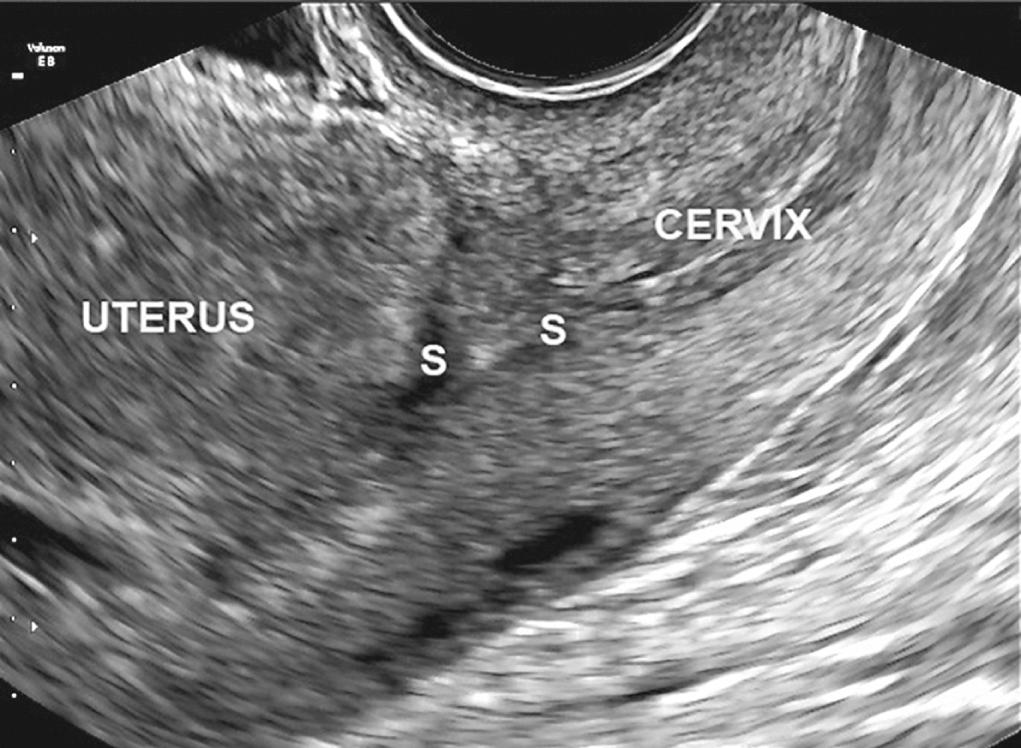 Fig. 21.3, Transvaginal Ultrasound View of the Uterus in a 5 Weeks Pregnancy After Two Previous Elective Cesarean Deliveries.