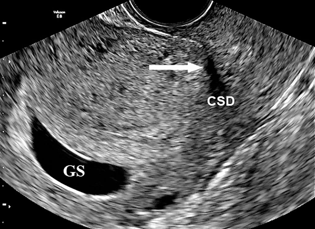Fig. 21.4, Transvaginal Ultrasound View of the Uterus in a 6-Week Gestational Sac (GS) After a Previous Emergency Cesarean Delivery.