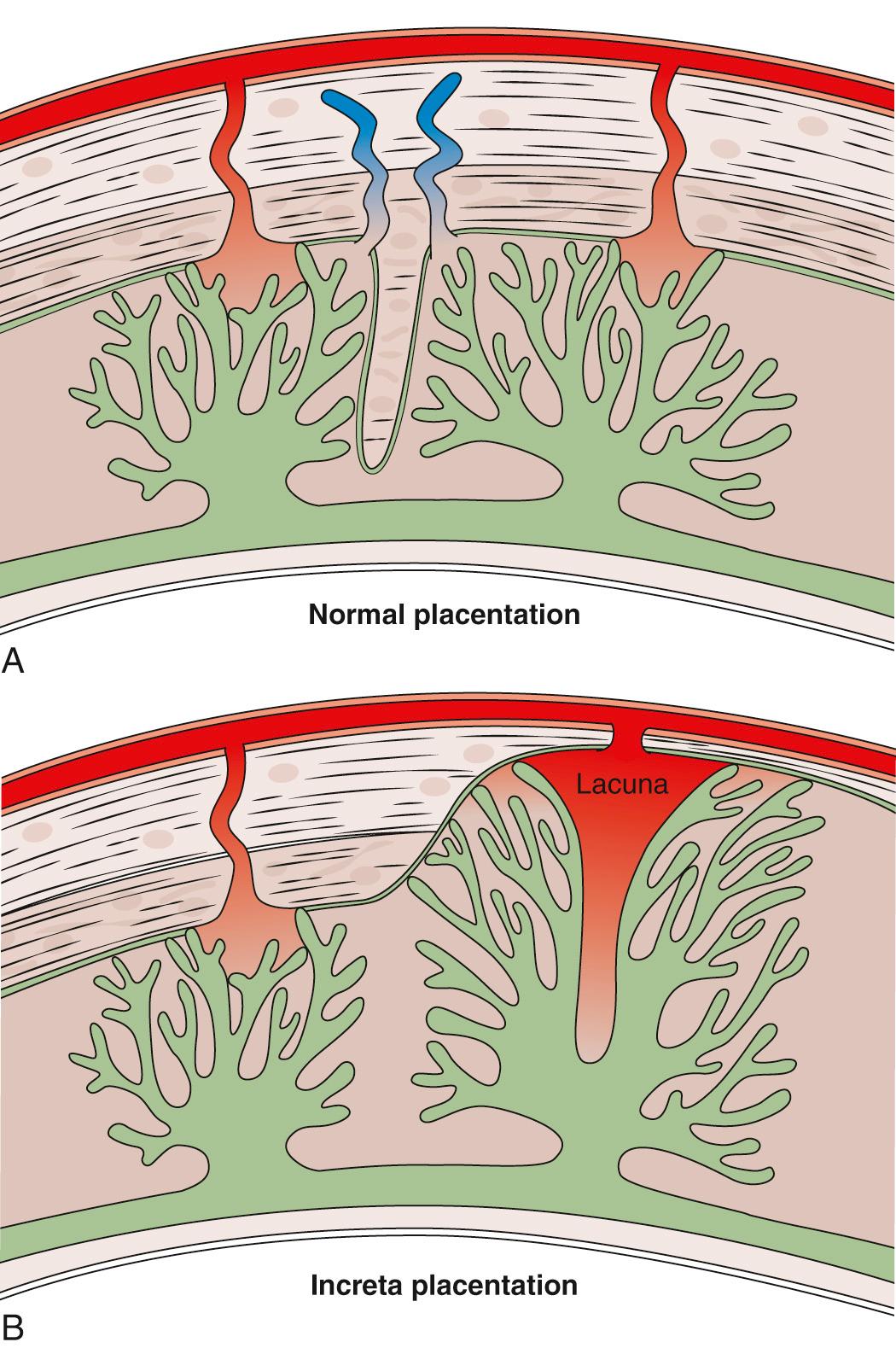 Fig. 21.5, Placental Cotyledon in Normal Placentation (A) and Increta Placentation (B) Reaching the Deep Myometrial Circulation.