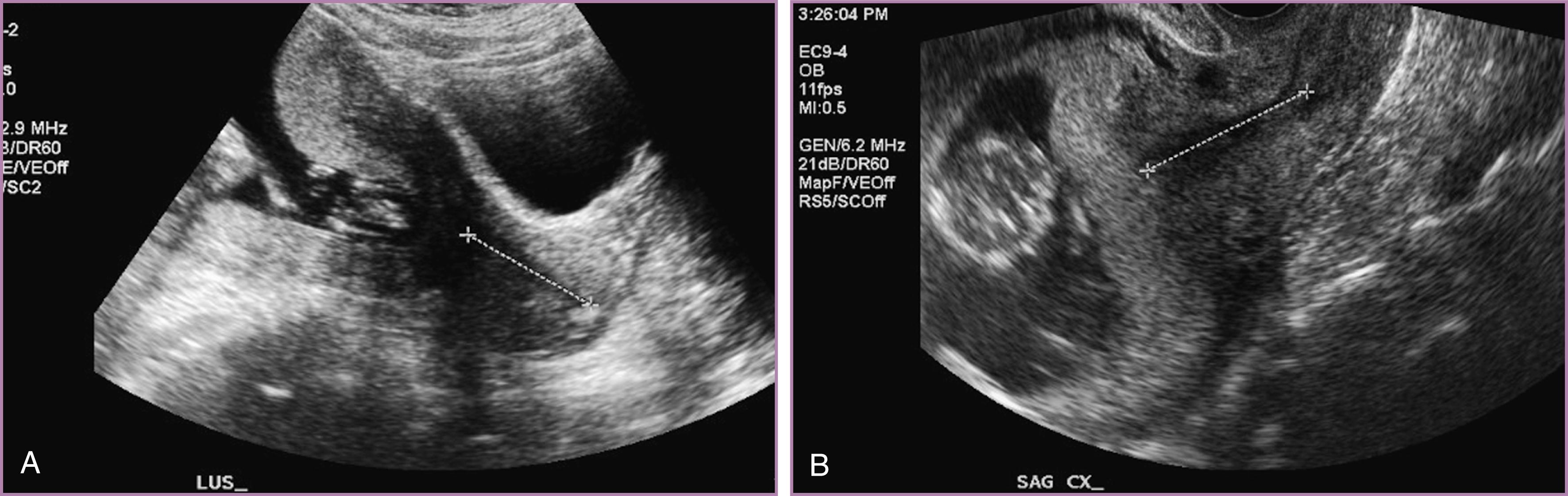 Figure 43.1, Ultrasound study performed at 18 weeks’ gestation for fetal anatomy survey.