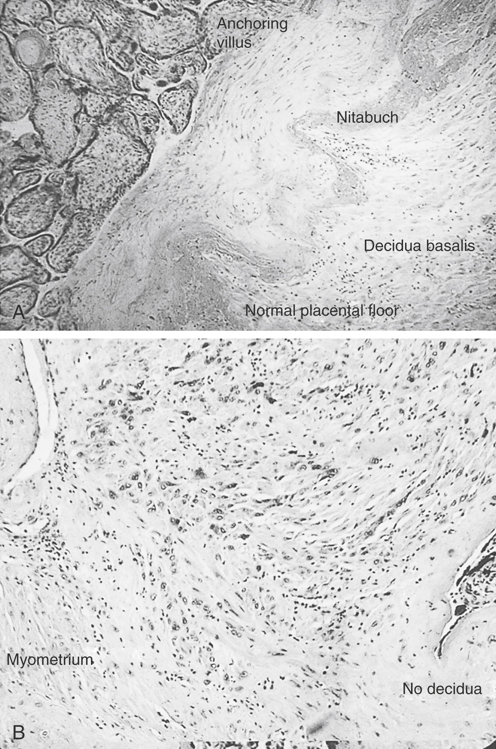 Figure 43.2, Histologic appearance of normal placental implantation and placenta accreta.