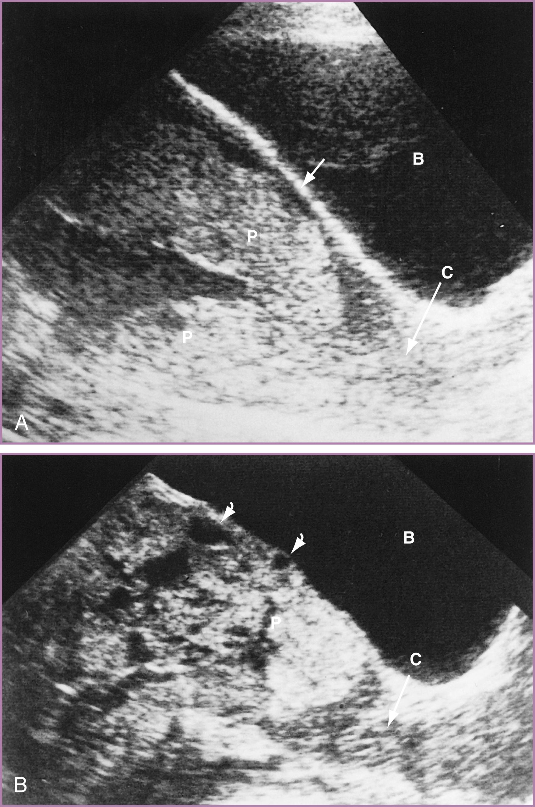 Figure 43.3, Ultrasound appearance of a normal placental implantation site and placenta accreta.
