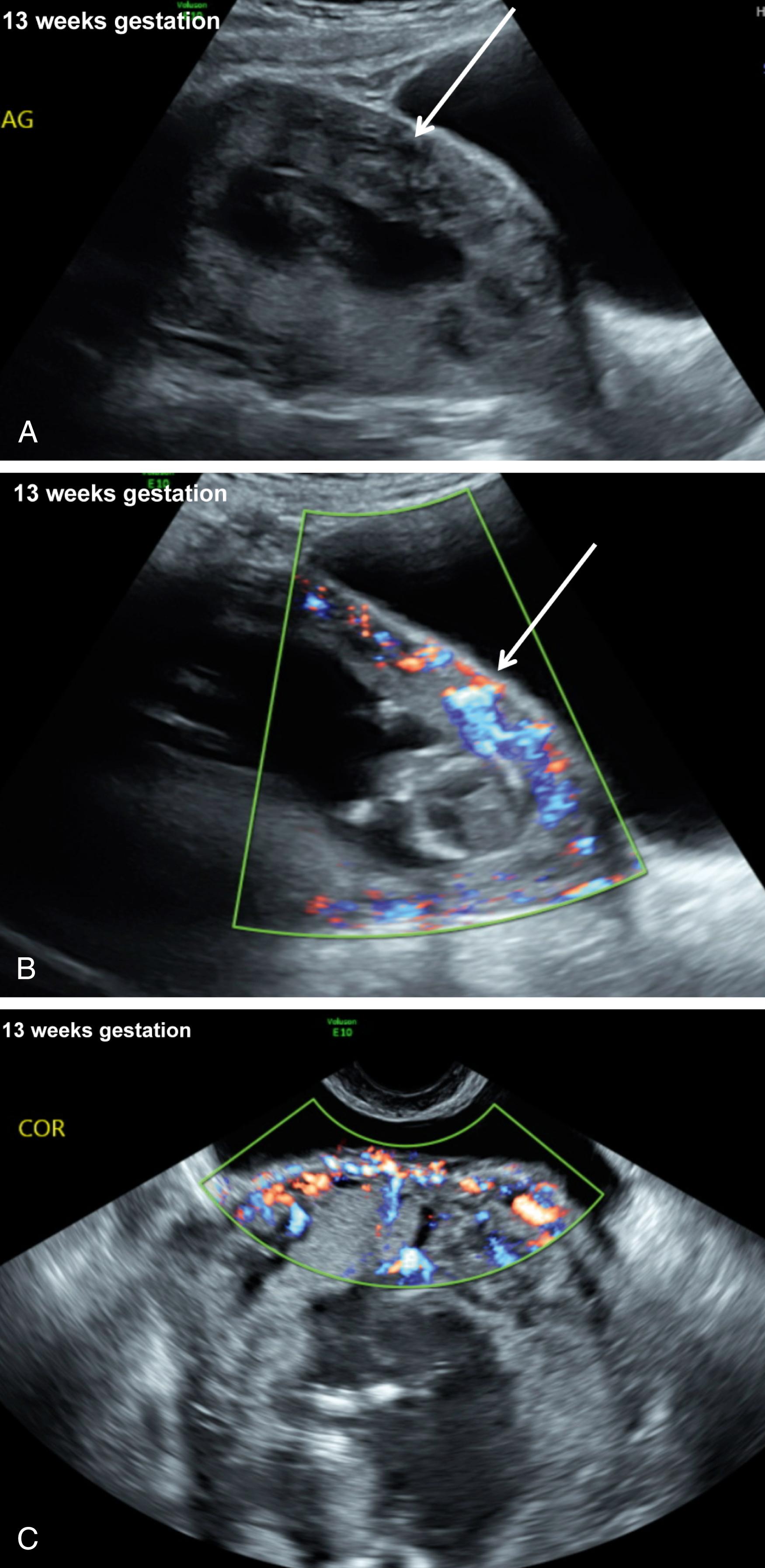 Figure 43.4, Characteristic appearance of a placenta accreta in the first trimester.