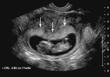 F igure 20-1, Placenta during the first trimester. Transvaginal image at 11 weeks 5 days shows the placenta as a layer of echogenic tissue (arrows) abutting the gestational sac. Calipers show measurement of crown-rump length of the embryo.