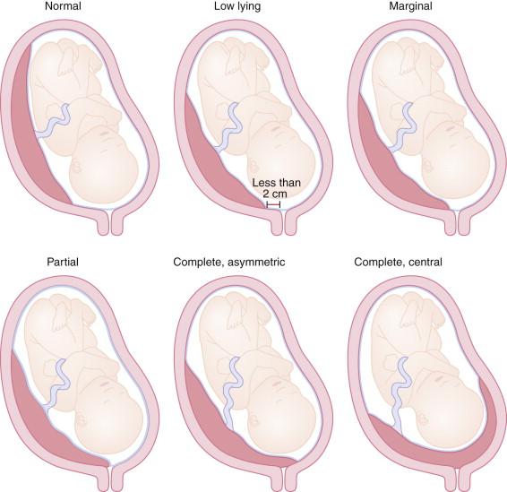 F igure 20-11, Placenta previa: schematic diagrams show categorization of placenta previa. Upper left , Normal placental location. Inferior edge of the placenta is more than 2 cm from the internal cervical os. Upper middle, Low-lying placenta. Distance between the inferior edge of the placenta and the internal cervical os is less than 2 cm. Upper right , Marginal placenta previa. Placenta covers part of the internal surface of the cervix without involving the internal cervical os. Lower left , Partial placenta previa. Placenta partially covers the internal cervical os. Lower middle, Complete placenta previa, asymmetric. Placenta is eccentrically situated over the cervix, completely covering the internal cervical os. Lower right , Complete placenta previa, central. Central portion of the placenta is located over the cervix, completely covering the internal cervical os.