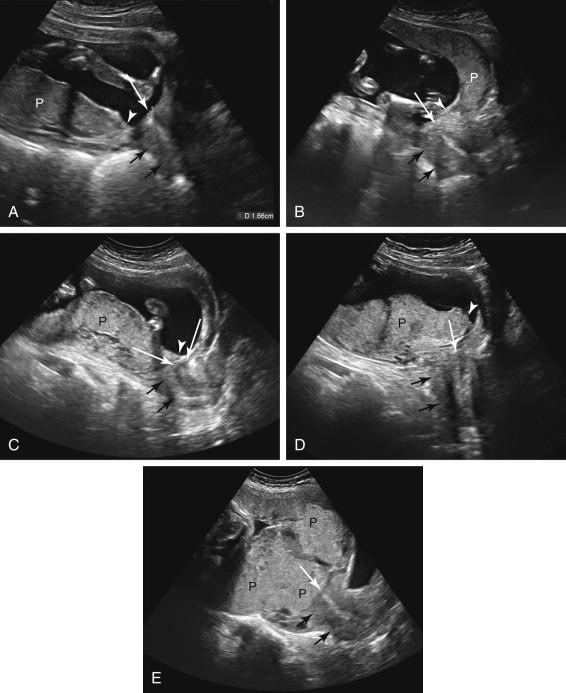 F igure 20-12, Placenta previa: transabdominal ultrasound examples. A, Low-lying placenta. Midline longitudinal image of the lower uterus and cervix shows that the inferior edge of the placenta (white arrowhead) ends 1.66 cm from the internal cervical os (long white arrow). B, Marginal placenta previa. Midline longitudinal image of the lower uterus and cervix shows an anterior placenta with the placental margin (white arrowhead) overlying the anterior portion of the cervix but not involving the internal cervical os (long white arrow). C, Partial placenta previa. Midline longitudinal image of the lower uterus and cervix shows a posterior placenta with the inferior placental margin (white arrowhead) partially covering the internal cervical os (long white arrows). D, Complete placenta previa, asymmetric. Midline longitudinal image of the uterus and cervix shows a majority of the placenta located posteriorly, with the lower margin of the placenta (white arrowhead) eccentrically covering the entire internal cervical os (long white arrow) but not extending significantly beyond the cervix. E, Complete placenta previa, central. Midline longitudinal image of the lower uterus and cervix shows the placenta centrally implanted over the cervix, completely covering the internal cervical os (white arrow). Black arrows , posterior margin of cervix; P, placenta.