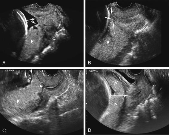 F igure 20-13, Placenta previa: transvaginal ultrasound examples. A, Marginal placenta previa. Midline longitudinal image of the cervix shows a posterior placenta with inferior placental edge (short arrow) partially covering the margin of the cervix but not involving the internal cervical os (long arrow) . B, Partial placenta previa. Midline longitudinal image of the cervix shows the inferior margin of a posterior placenta (short arrow) partially covering the internal cervical os (long arrows) . C, Complete placenta previa, asymmetric. Midline longitudinal image of the cervix shows a posterior placenta completely covering the internal cervical os (long arrow) with the lower edge of the placenta (arrowhead) not extending significantly beyond the cervix. D, Complete placenta previa, central. Midline longitudinal image of the cervix shows placental tissue centrally implanted over the internal cervical os (long arrow) . P, Placenta.