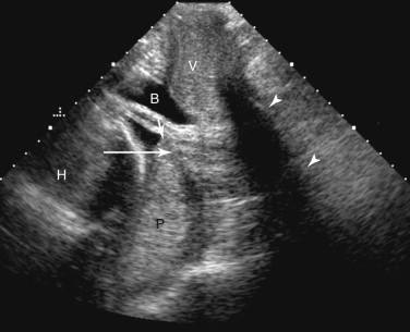 F igure 20-14, Complete placenta previa, asymmetric: transperineal ultrasound example. Midline longitudinal image of the cervix using the transperineal ultrasound approach shows the lower edge of the placenta (short arrow) eccentrically overlying the internal cervical os (long arrow) but not extending beyond the cervix. Note that shadowing from gas in the rectum (arrowheads) obscures the inferior margin of the cervix. B, Bladder; H, fetal head; P, placenta; V, vagina.