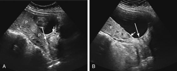 F igure 20-15, Interval resolution of placenta previa. A, Midline longitudinal transabdominal image of the lower uterus and cervix at 16 weeks gestation shows an apparent asymmetric complete placenta previa covering the internal cervical os (long arrow) . Short arrow, inferior margin of the placenta. B, Midline longitudinal transabdominal image of the cervix and lower uterus obtained at 26 weeks gestation in the same patient as in image A shows that the previously identified placenta previa has resolved. The inferior placental edge (short arrow) no longer covers the internal cervical os (long arrow) . P, Placenta.