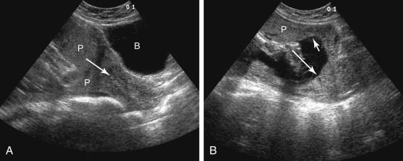 F igure 20-16, Full urinary bladder causing false-positive appearance of placenta previa. A, Midline longitudinal transabdominal image of the lower uterus and cervix obtained with full maternal urinary bladder (B) shows that placental tissue appears to cover the internal cervical os (arrow) . B, Corresponding image obtained after the patient emptied her bladder shows the lower edge of the placenta (short arrow) separate from the cervix and internal cervical os (long arrow) . P, Placenta.