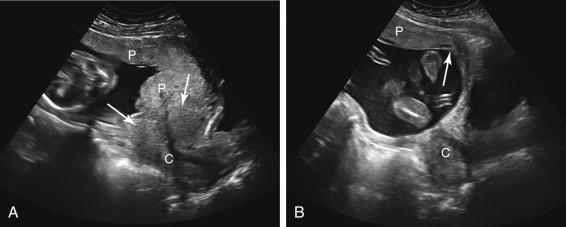 F igure 20-17, False-positive appearance of placenta previa due to a lower uterine contraction. A, Longitudinal transabdominal image of the lower uterus and cervix shows placenta extending over apparent region of the cervix. Note the distorted appearance of the cervix due to a circumferential contraction (arrows) in the lower uterus. B, Image of the lower uterus and cervix obtained 39 minutes after the image in A shows interval resolution of the uterine contraction. The lower edge of the placenta (arrow) is now located remote from the cervix. C, Cervix; P, placenta.