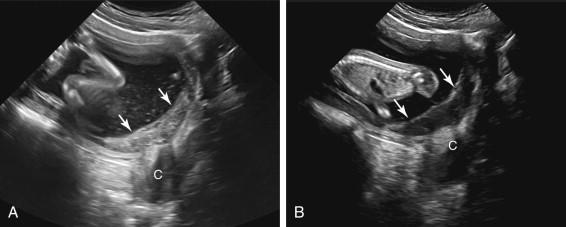 F igure 20-18, Subchorionic hematoma resembling the appearance of placenta previa. A, Midline longitudinal transabdominal image of the lower uterus and cervix shows an echogenic subchorionic hematoma (short arrows) overlying the cervix, resembling the appearance of placenta previa. Also note the presence of internal echoes in the amniotic fluid, due to bleeding into the amniotic cavity. B, Midline longitudinal transabdominal image of the lower uterus and cervix obtained 11 days after the image in A shows interval evolution of the subchorionic hematoma, which has decreased in echogenicity and no longer resembles placental tissue. The elevated amniochorionic membrane (short arrows) is now clearly seen demarcating the margin of the hematoma because the hematoma itself has decreased in echogenicity. C, Cervix.