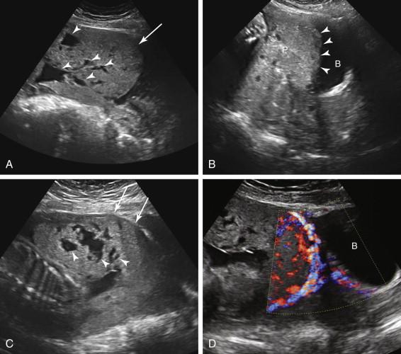 F igure 20-19, A, Placenta accreta: ultrasound findings in different patients. A, Longitudinal transabdominal image of the lower uterus and cervix reveals thickening and anterior bulging of the placenta (long arrow) in the lower uterus with intraplacental lacunae (arrowheads) due to placenta percreta. B, Longitudinal transabdominal image of the lower uterus and cervix in a different patient with placenta percreta shows thickening and anterior bulging of the placenta (P) with irregular projections of soft tissue (arrowheads) into the urinary bladder (B) due to invasion by placental tissue. C, Longitudinal transabdominal image of the lower uterus during the third trimester shows multiple lacunae (arrowheads) in the placenta in the setting of placenta increta. The uterine wall is thinned in the region of abnormal placental attachment (long arrows) . D, Longitudinal transabdominal image of the lower uterus with color Doppler in a patient with placenta accreta shows prominent retroplacental and intraplacental vascularity. B, Bladder.