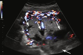 e -F igure 20-1, Oblique transabdominal image with color Doppler in the same patient as in Video 20-6 shows multiple prominent lacunae (arrows) with no blood flow identified in the lacunae at color Doppler.