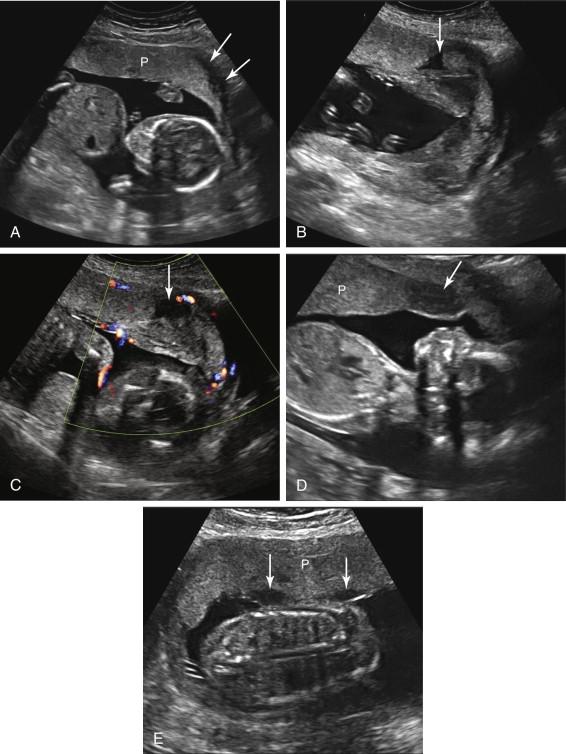 F igure 20-2, Normal hypoechoic structures in the placental region. A, Hypoechoic retroplacental layer. Longitudinal image shows a hypoechoic region behind the placenta (arrows) , corresponding to the myometrium and blood vessels. B and C, Intervillous space. Longitudinal gray-scale (B) and color Doppler (C) images show an intraplacental hypoechoic structure (arrows) with no flow identified at color Doppler. Blood flow in intervillous spaces may be too slow to be depicted at color Doppler. Swirling echoes were seen in the intervillous space at real-time gray-scale evaluation (see Video 20-1 ). D, Marginal sinus. Longitudinal image shows a hypoechoic area along the inferior margin of the placenta (arrow) corresponding to a marginal sinus. E, Subchorionic fibrin deposition. Longitudinal image shows an anterior placenta with hypoechoic structures (arrows) along the fetal surface of the placenta. No blood flow was observed in these foci, consistent with subchorionic fibrin deposition. P, Placenta.