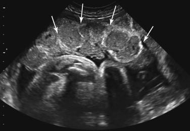 F igure 20-3, Placental calcifications. Transverse image of the placenta at 38 weeks shows curvilinear echogenic foci (arrows) due to calcifications.