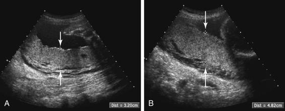 F igure 20-4, Placental thickness measurement. A, Correct placement of measurement calipers. Longitudinal image of a normal placenta at 29 weeks shows measurement calipers (arrows) appropriately positioned on the anterior and posterior margins of the placenta, perpendicular to the long axis of the placenta. The placental thickness measurement of 3.2 cm is normal. B, Incorrect measurement technique. Oblique image through the normal placenta in the same patient as in A , with measurement calipers (arrows) positioned in an oblique orientation, rather than perpendicular to the long axis of the placenta, spuriously increases the measurement. The placental thickness measurement of 4.8 cm is abnormally elevated despite normal placental thickness.