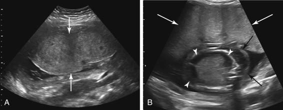 F igure 20-5, Thick placenta. A, Gestational diabetes. Longitudinal image of the gravid uterus during the third trimester shows a thick placenta (arrows) due to gestational diabetes. B, Parvovirus infection. Transverse image of the uterus in a different patient during the late second trimester shows a thick placenta (long white arrows) due to parvovirus infection. There is also evidence of fetal hydrops, with fetal ascites (white arrowheads) and skin thickening (black arrows).