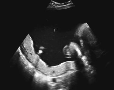 F igure 20-6, Thin placenta due to severe polyhydramnios. Transverse image of the uterus during the third trimester shows a thin-appearing placenta (P) and a large amount of amniotic fluid (F). The placenta is thin because it is stretched and compressed along the inner surface of the uterus by severe polyhydramnios. Other etiologies for a thin placenta include insulin-dependent diabetes and chronic hypertension.