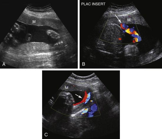 F igure 20-7, Succenturiate lobe of the placenta. A, Longitudinal gray-scale image of the uterus shows two separate placental lobes. The main lobe (M) is located anteriorly and the succenturiate lobe (S) is located posteriorly. B, Oblique image of the uterus with color Doppler in the same patient as in A shows that the umbilical cord insertion (arrow) is into the main lobe of placenta (M). C, Transverse image of the left lateral portion of the uterus with color Doppler shows blood vessels (arrow) traveling from the main lobe of placenta (M) posteriorly toward the succenturiate lobe.