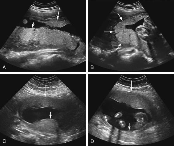 F igure 20-8, Pitfalls in identification of succenturiate lobe. A and B, Anterior and posterior components of a normal placenta. A, Longitudinal midline image of the uterus in the second trimester shows small anterior (long arrow) and large posterior (short arrow) components of the placenta, resembling the appearance of an anterior succenturiate lobe. B, Transverse image of the right side of the uterus demonstrates placental tissue along the right lateral wall of the uterus (arrows) connecting the anterior and posterior components of the placenta seen in image A . C and D, Uterine contraction resembling succenturiate lobe. C, Longitudinal image of the uterus in a different patient shows placental tissue anteriorly (long arrow) and apparent succenturiate lobe of placenta posteriorly (short arrow) . D, Longitudinal image of the same patient as in C obtained 20 minutes later confirms the presence of an anterior placenta (long arrow) but shows no evidence of the previously seen candidate posterior succenturiate lobe (short arrow) due to resolution of a posterior uterine contraction.