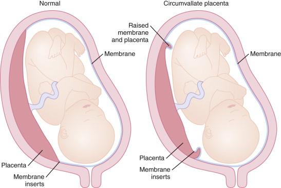 F igure 20-9, Schematic diagram comparing normal placenta (left) and circumvallate placenta (right). The membranes insert at the edge of the normal placenta, whereas they insert on the anterior surface of the circumvallate placenta, central to the placental edge. As a result, the circumvallate placenta has a raised rolled layer of thickened membranes and placental tissue resulting in a clublike appearance of the placental edge.