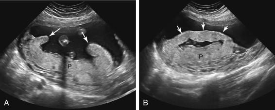 F igure 20-10, Circumvallate placenta. A, Longitudinal image of the uterus during late second trimester shows a posterior placenta (P) with raised edges in a clublike configuration (arrows) due to circumvallate placenta. B, Oblique image of the same placenta (P) as in image A depicts the raised edge of the placenta as a linear band of tissue (arrows) that resembles a uterine synechia.