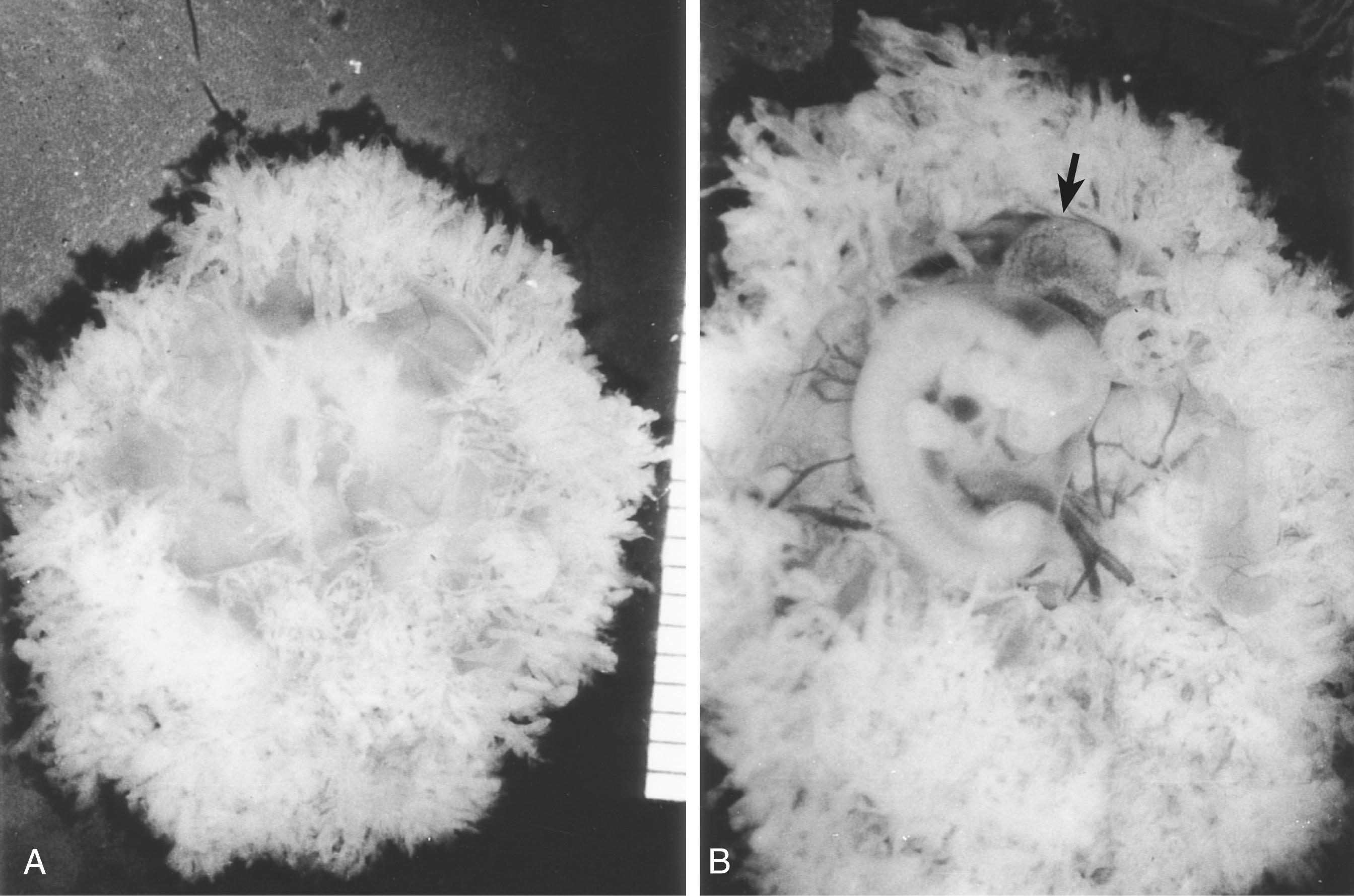 Fig. 7.10, (A) Intact chorionic vesicle containing an embryo in the fourth week of development. The outline of the embryo can be seen through the thinned chorion laeve region. (B) Opened chorionic vesicle, showing the disposition of the embryo inside. The yolk sac is indicated by the arrow .