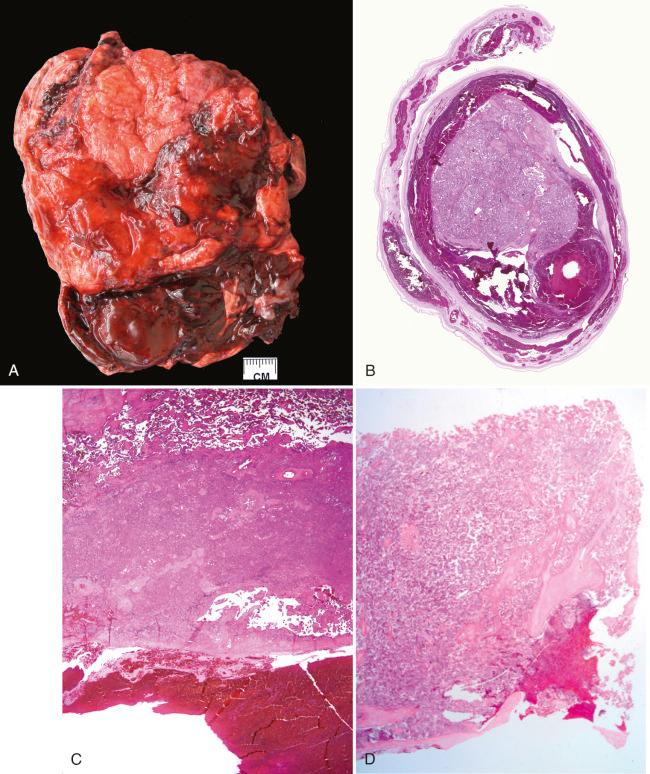 Fig. 32.1, Lower-power composite photographs of recent placental abruption. A, Marginal/retroplacental hematoma, dissecting beneath the membranes, seen here with the membrane roll. B, Large abruption with retroplacental thrombus and depression seen in the lower aspect of the image. C, Retroplacental hematoma with overlying placental infarction (collapsed intervillous space). D, Retroplacental bleeding has dissected into the basal intervillous space to produce intervillous hemorrhage, defined as a space-occupying maternal bleed.