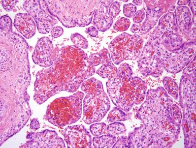 Fig. 32.2, Intravillous hemorrhage. In the context of placental abruption, this finding evolves rapidly as a consequence of placental shearing.