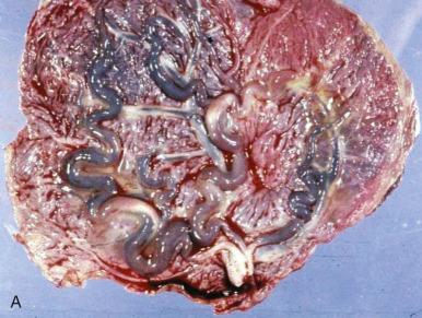 Fig. 32.4, Gross and histologic changes of fetal vascular malperfusion. A, Placenta from a diabetic patient with both recent (dilated dark red) and remote (white) thrombosis in chorionic plate vessels. B, Placenta with a 103-cm umbilical cord and calcified thrombosis in a chorionic plate vessel. C, Close-up of thrombosed vessel in B. D, Eosinophilic fibrin cushion in a chorionic plate vessel. E, Early thrombosis with loss of integrity of endothelial lining and extravasation of fragmented red cells into the vessel wall. F, Organized thrombus in a dilated chorionic plate vessel. G, Villus stromal karyorrhexis in a stem villus vessel, the downstream effect of upstream fetal blood flow cessation. H, Calcified thrombus in a chorionic plate vessel.