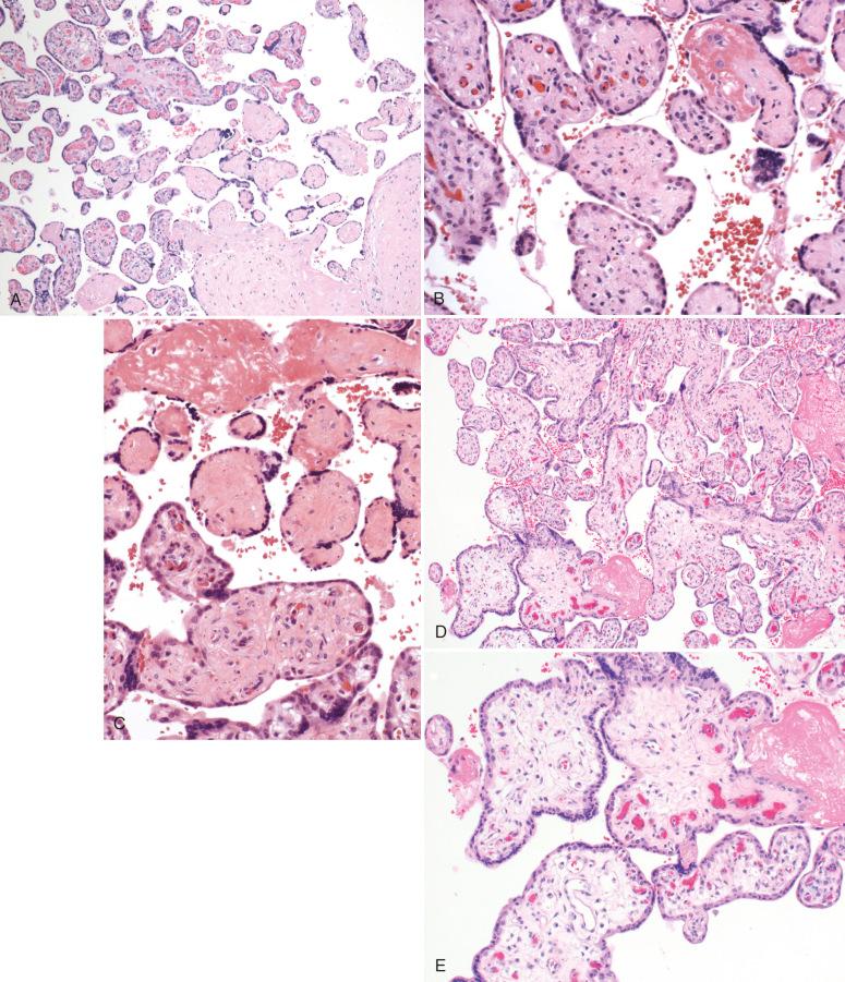 Fig. 32.5, Villous patterns of fetal blood flow restriction. A to C, Fetal thrombotic vasculopathy (FTV). A, Collagenized avascular villi (bottom right) stand out in comparison to the normal vascular terminal villi (above left). B, Villus stromal karyorrhexis is an intermediate lesion, characterized by fragmented red blood cells and karyorrhectic debris overlying terminal villi with few vascular remnants. C, Completely avascular villi (top). Note temporal heterogeneity of FTV in all three panels. D to E, Delayed villous maturation, near-term placenta. D, Note large and immature-appearing villi with few syncytial knots. E, At higher magnification, villous capillaries are centrally placed.