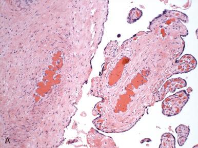 Fig. 32.6, Lesions previously referred to as hemorrhagic endovasculitis. A, Vascular involution of stem villus vessels, characterized by bands of fibrosis present in nondilated vessels, is a passive change. B, Disruption of endothelial lining and extravasation of red cells into the vascular wall, the classic lesion of hemorrhagic endovasculitis, can be seen both as a postmortem change and as a lesion associated with “active” (antemortem) thrombosis. To distinguish between the two, the distribution of the lesion should be noted; if seen throughout the placenta, along with diffusely distributed avascular villi, it is likely a postmortem change, whereas if focal and associated with fetal thrombotic vasculopathy (FTV) (focal or regional distribution of avascular villi; see Fig. 32.5A ), it is likely to have occurred premortem and to be a cause of fetal demise.