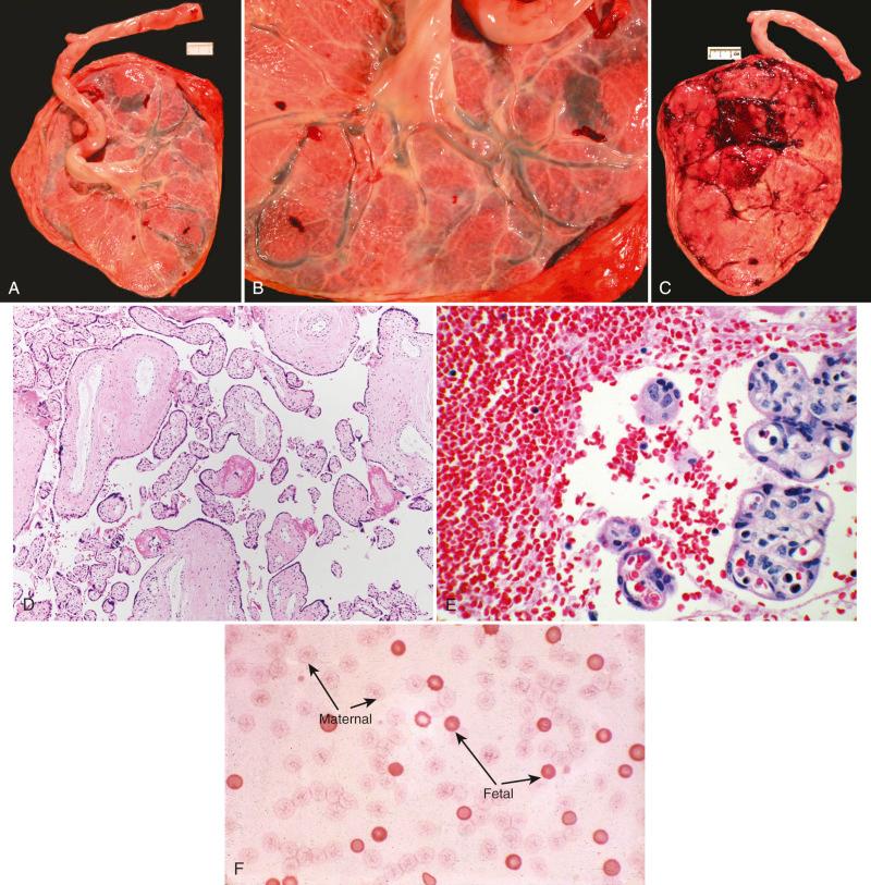 Fig. 32.7, Fetal/maternal hemorrhage. Low-power (A) and high-power (B) views of hypovolemic to euvolemic fetal surface vessels having been drained as a consequence of intervillous blood loss. C , The ventral surface of this placenta exhibits marked pallor. D, Profoundly hypovolemic villus vessels. E, Nucleated fetal erythrocytes in villous capillaries and within the fresh intervillous thrombus, the latter attesting to the site of fetal/maternal bleeding. F, Positive Kleihauer-Betke test, confirming fetal/maternal hemorrhage.