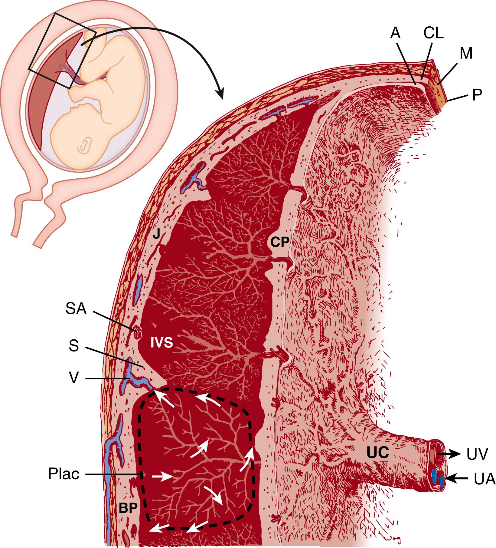 Fig. 8.1, Survey diagram of the mature human placenta in situ. Villous trees arranged around maternal arterial flow from spiral arteries are a central feature of the placenta. Inflowing maternal blood circulates within the intervillous space (arrows) , bathing the villous trees, and exits through maternal veins. A, Amnion; BP, basal plate; CL, chorion laeve; CP, chorionic plate; IVS, intervillous space; J , junctional zone; M, myometrium; P, perimetrium; Plac , placentome; S, placental septum; SA , maternal spiral artery; UA, umbilical artery; UC, umbilical cord; UV, umbilical vein; V , maternal vein.