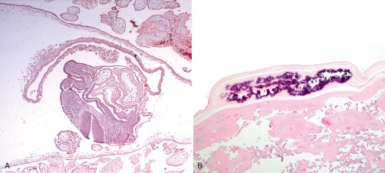 Fig. 29.1, A, Early embryo (center), around 6 to 7 weeks' gestational age, and secondary yolk sac (directly above) within a villous chorionic (gestational) sac (as seen sonographically in Fig. 29.10 ). B, Yolk sac remnant in a term placenta, appearing as a calcified area in the chorionic plate.