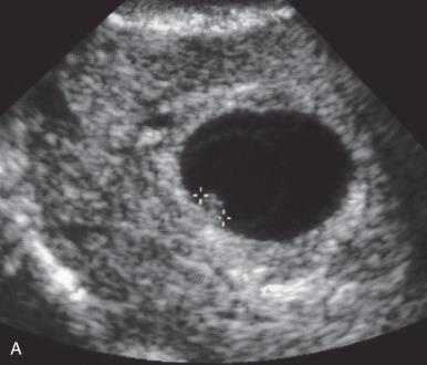 Fig. 29.11, A, Sonogram of abnormal intrauterine gestation containing a small embryonic pole (calipers) that had no heartbeat, representing a failed pregnancy. B, Blighted ovum at 8 weeks' gestational age. C, Normal fetus at approximately 10 weeks' gestational age. D, Embryos at approximately 5, 7, and 8 weeks' gestational ages (bottom to top).