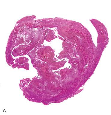 Fig. 29.15, A, Early pregnancy within a blood clot. B, Attention to the center of the clot often discloses a few villi and trophoblasts.