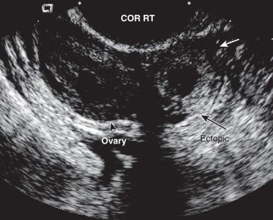 Fig. 29.16, Tubal ectopic pregnancy. This coronal sonographic image of the right adnexa demonstrates a well-defined mass (arrows) adjacent to but separate from the ovary (arrowhead) . Within the mass was an embryo with a visible heartbeat, confirming the diagnosis of an ectopic pregnancy.