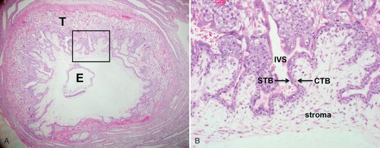 Fig. 29.2, A, Early embryo (E), around 4 to 5 weeks' gestational age, with a thick trophoblastic shell (T). The bracketed area is shown in more detail in B . B, Primary villi are shown with cytotrophoblast (CTB), syncytiotrophoblast (STB), intervillous space (IVS), and chorionic stroma (stroma) marked.