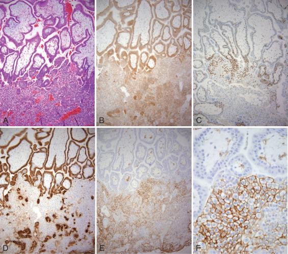 Fig. 29.4, Extravillous trophoblast in the first-trimester implantation site. A, The trophoblastic columns merge with the early implantation site (below). B, p63 immunostaining (nuclear) is confined to the cytotrophoblast, inner layer of trophoblast in the chorionic villi. C, Proliferative MIB-1 activity extends beyond the cytotrophoblast into the columns; then it diminishes in the extravillous trophoblast below. D, β-hCG stains the syncytiotrophoblast and the multinucleated trophoblast in the implantation site below. E, MelCAM localizes to the distal columns and the extravillous implantation site trophoblast below. F, Higher magnification of E , highlighting the membranous localization of MelCAM.