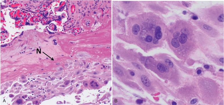 Fig. 29.5, Extravillous trophoblast at the basal plate of a term placenta. A, Chorionic villi (top) are separated from extravillous trophoblast and decidua (below) by a thick layer of Nitabuch's fibrin (N; arrow ). B, Extravillous trophoblast giant cells at the basal plate.