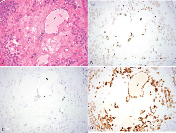 Fig. 29.6, Trophoblastic differentiation in an intraplacental trophoblast island. A, Hematoxylin and eosin (H&E)–stained section illustrates the villus in the center, entrapped in fibrin, with scattered trophoblasts in the periphery. B, p63 immunostaining highlights the vacuolated or transitional trophoblast, in which a few MIB-1–positive cells are seen (C). D, Inhibin staining highlights in particular the mature extravillous trophoblast in the periphery.