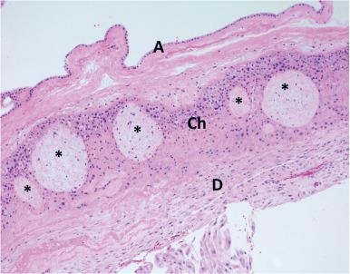 Fig. 29.7, Fetal membrane at term. H&E-stained section illustrates a typical fetal membrane with amnion (A) at the top, chorionic trophoblast (Ch) in the middle, and decidua (D) at the bottom. Note the presence of several villous ghosts (marked by *) in the chorionic-trophoblast layer.