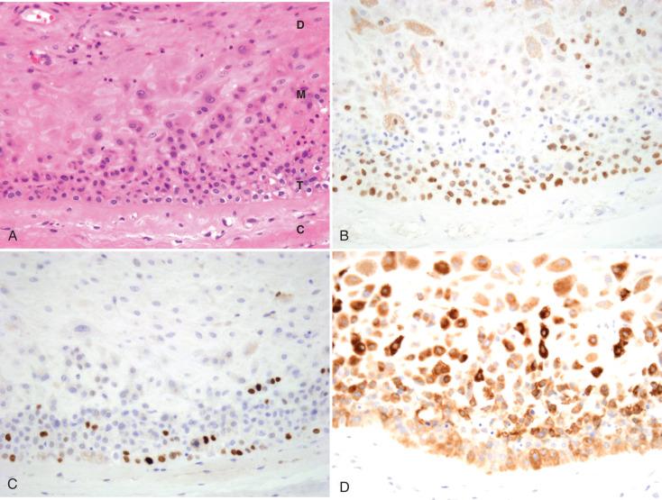 Fig. 29.8, Immunophenotype of fetal membranes. A, Decidua (D), mature (M) and transitional (T) trophoblasts, and chorionic membrane (C) are noted. B, p63 staining highlights the transitional trophoblast and diminishes in the mature membranous trophoblast. C, Proliferative activity (MIB-1) is more restricted. D, Inhibin staining is more intense in the maturing component away from the membrane.