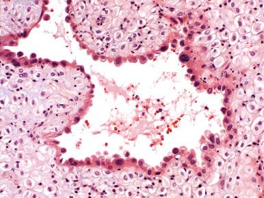 Fig. 29.9, Arias-Stella reaction in a gestational endometrial gland, characterized by hyperchromatic polyploid nuclei and surrounded by decidualized stroma.