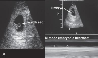 Fig. 29.10, Sonographic findings in early gestation. A, A 6- to 7-week live intrauterine pregnancy. The embryo is marked by calipers in the image on the right and with an arrow on the left. The normal yolk sac (arrow) is visible adjacent to the embryo. The M-mode beneath the left image demonstrates embryonic cardiac activity. B, Empty gestational sac. This image of failed intrauterine gestation at approximately 8 weeks' gestation demonstrates a large gestational sac (calipers) within the uterus, with no embryo present.